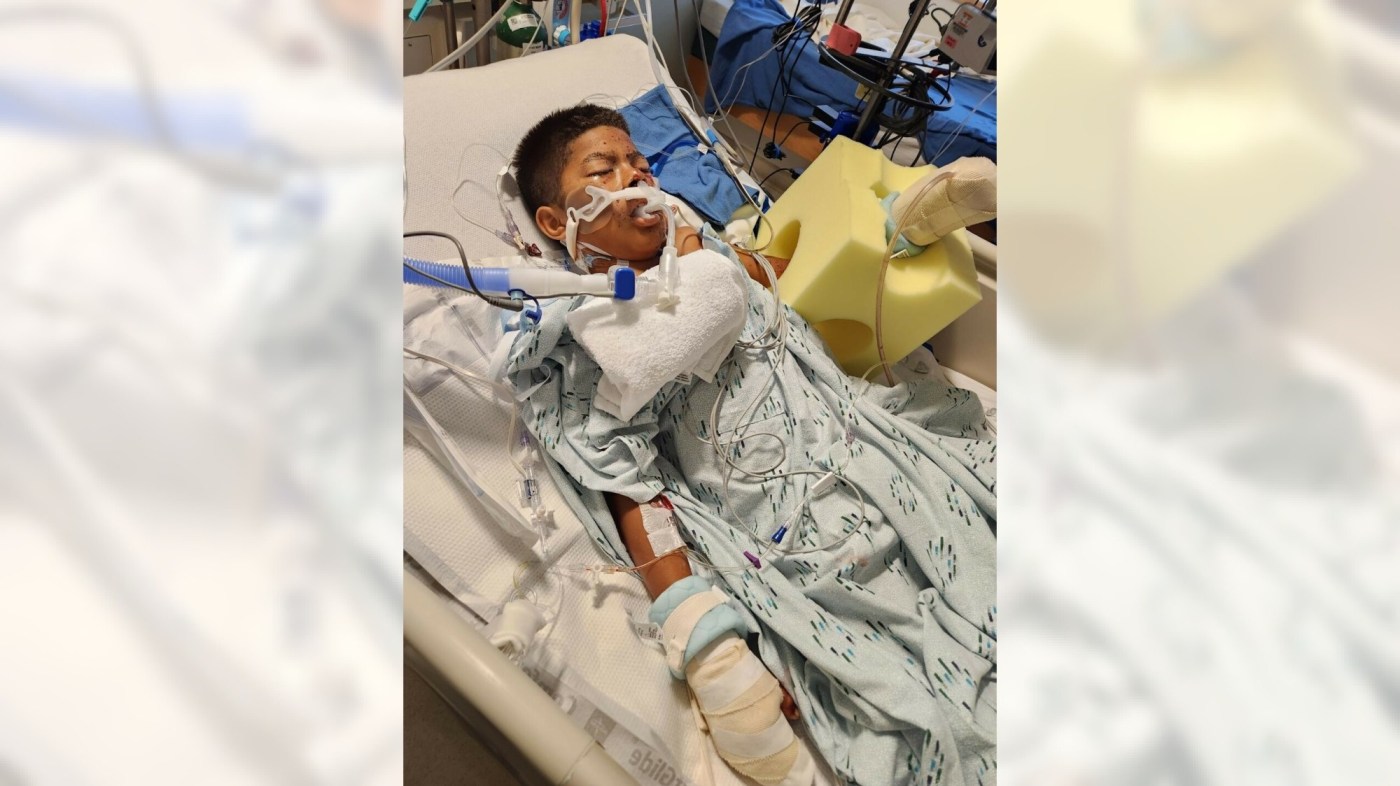 Boy, 10, loses 3 fingers after a firework explodes in his hand in San Juan Capistrano 1 OCR L EXPLODE 0712 06 K6k3E2