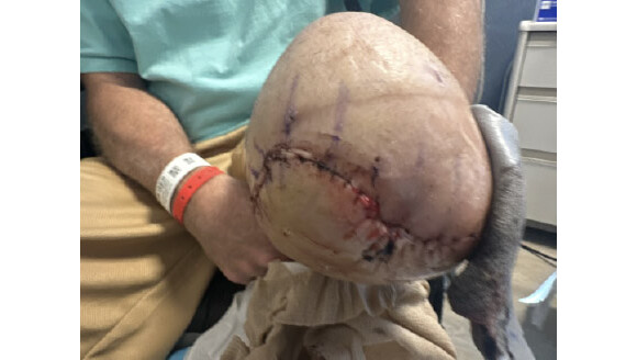 UCI Medical Center patient loses left leg after undergoing routine knee surgery 1 OCR L UCIMEDICAL 022 16x9 1 rd6LQy